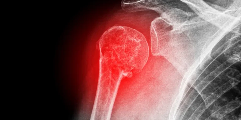 Quando uma Fratura no ombro precisa de cirurgia? Fratura no ombro precisa de cirurgia